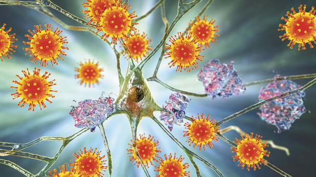 Les lésions cérébrales sont-elles responsables de la covidie à long terme ?