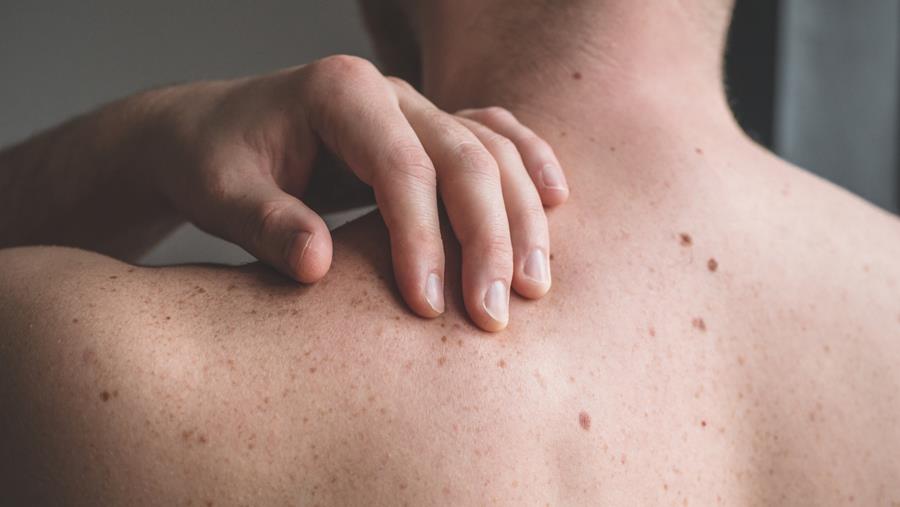 Une molécule d’ARN aide les cellules de mélanome à échapper au système immunitaire