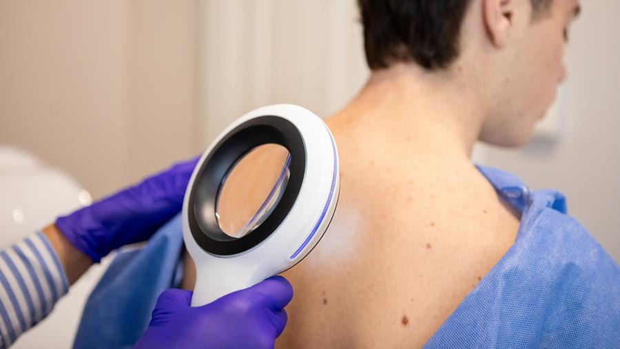 UZ Brussel start met TIL-therapie bij agressieve huidkanker